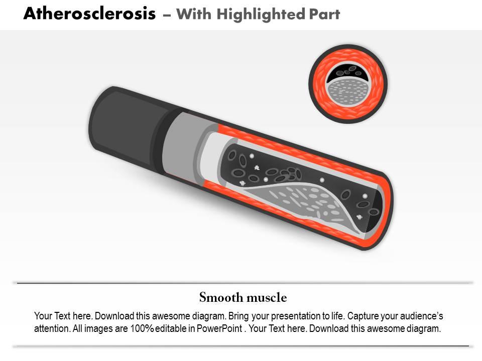 0814 Atherosclerosis Medical Images For Powerpoint | Graphics Presentation  | Background for PowerPoint | PPT Designs | Slide Designs