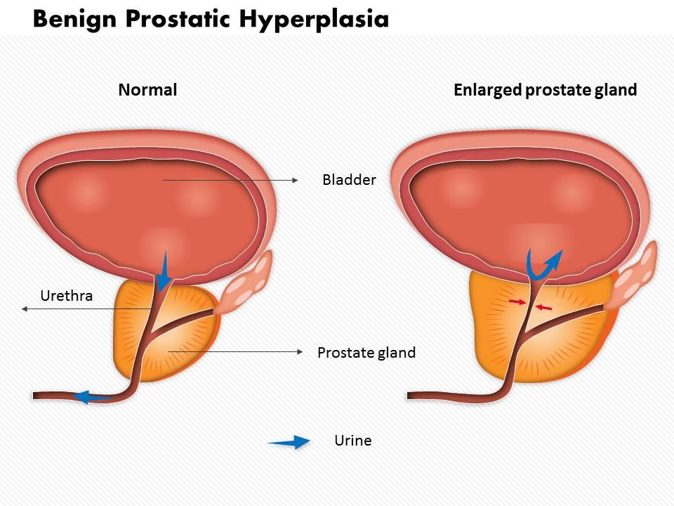 How long does an enlarged prostate last