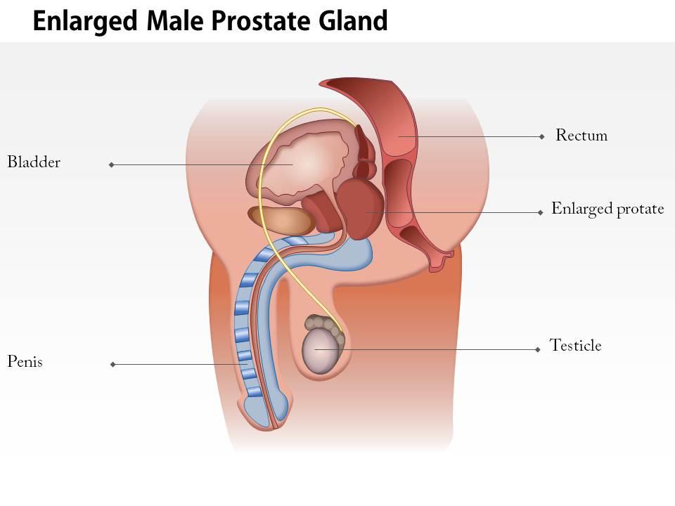 0814 illustration of an enlarged male prostate gland medical images for powerpoint Slide01