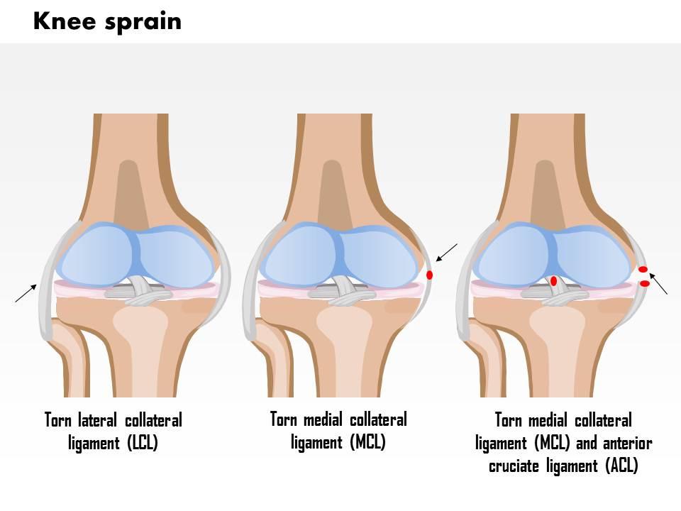 0814 knee sprain medical images for powerpoint Slide00