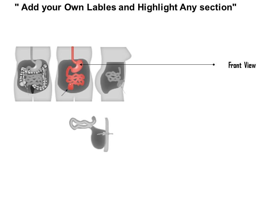 0814 Kock Pouch Colon Surgery Medical Images For Powerpoint