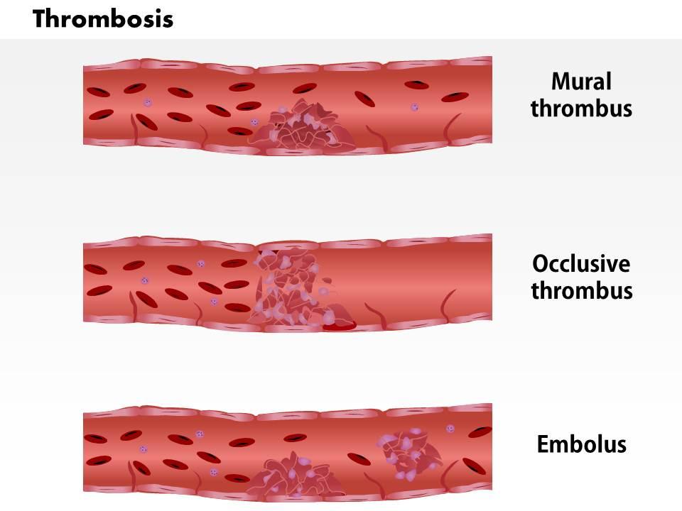0814 types of thrombosis medical images for powerpoint Slide00