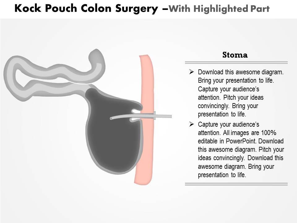 0914 Kock Pouch Colon Surgery Medical Images For PowerPoint