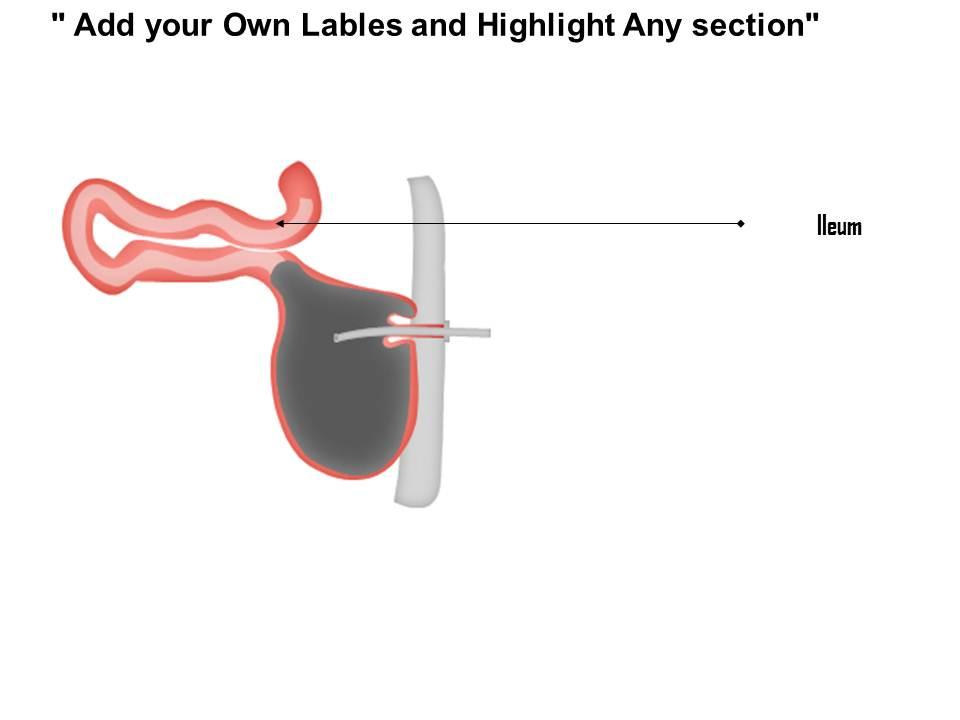 0914 Kock Pouch Colon Surgery Medical Images For PowerPoint