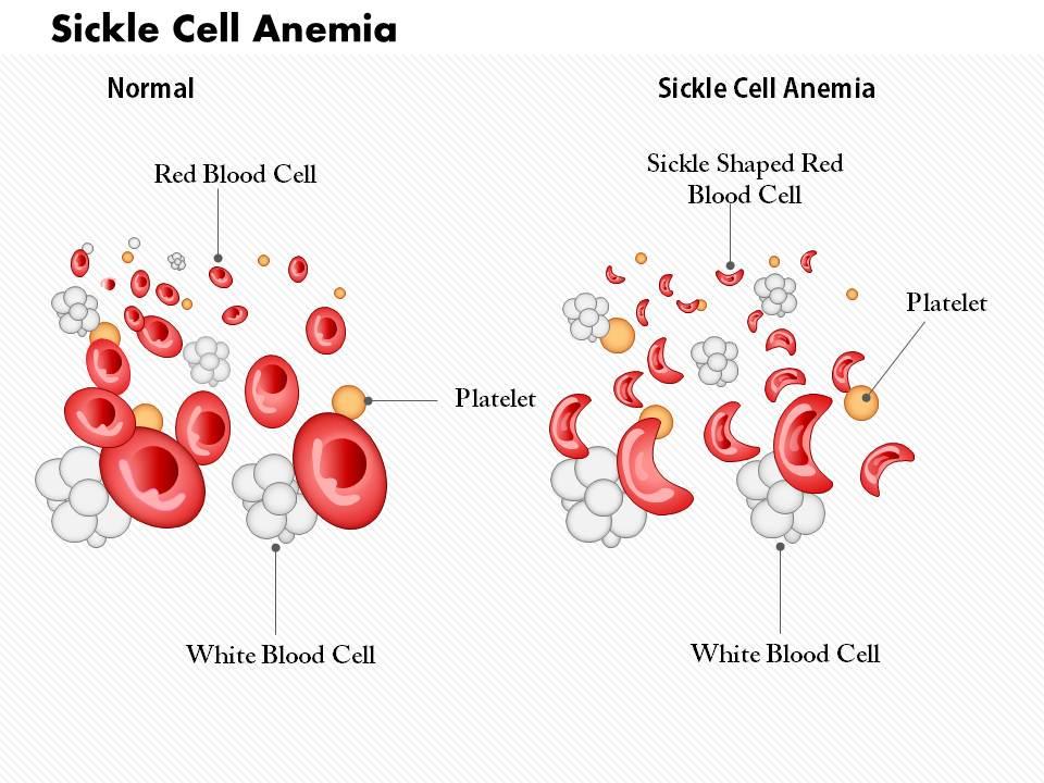 iron deficiency anemia slide