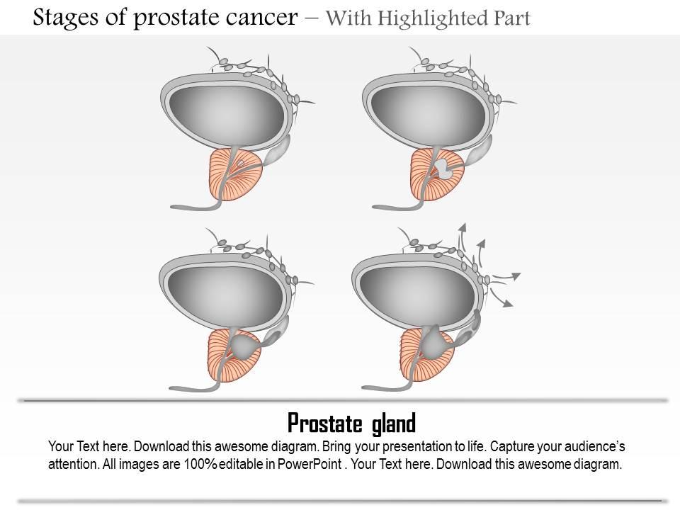 prostatitis krónikus medence krónikus prosztatitis fáj a vese