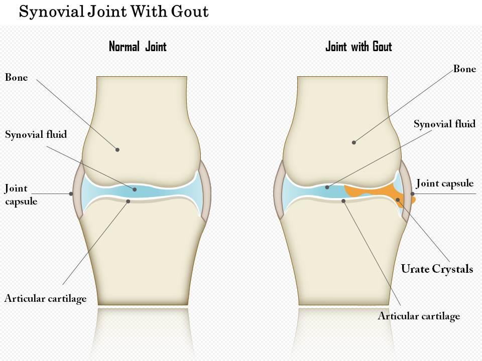 0914 Synovial Joint With Gout Medical Images For PowerPoint ...