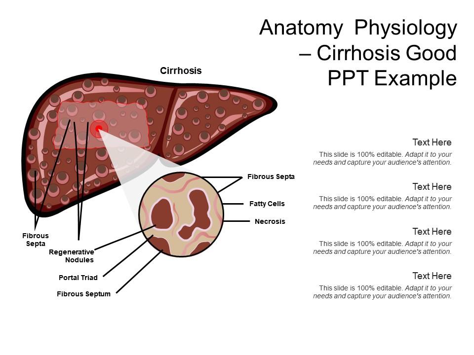 anatomy_physiology_cirrhosis_good_ppt_example_Slide01