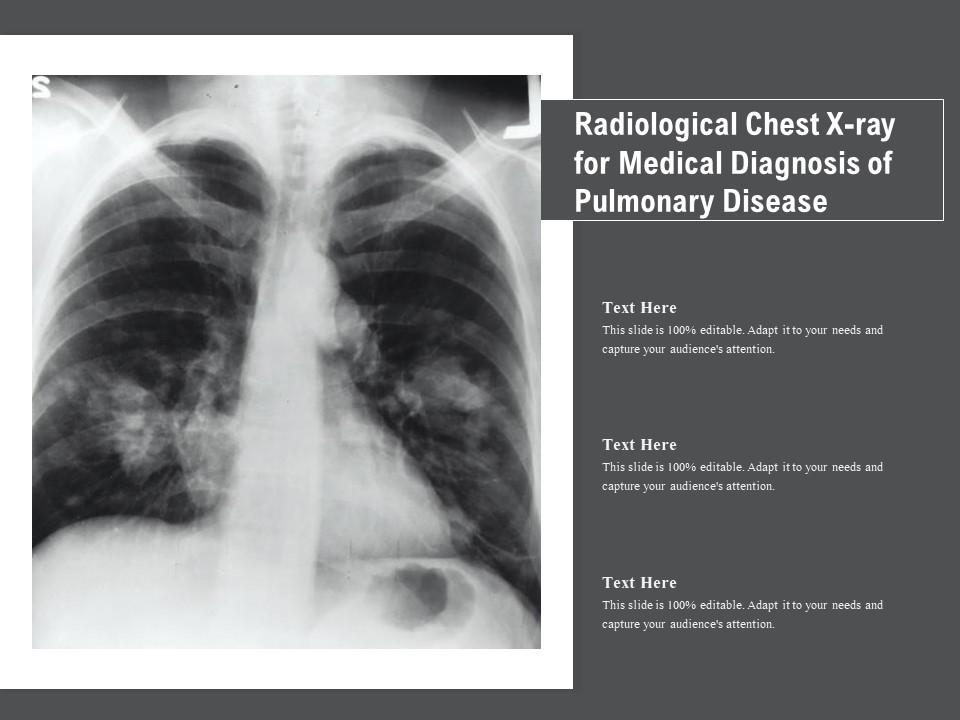 Radiological Chest X Ray For Medical Diagnosis Of Pulmonary Disease Presentation Graphics