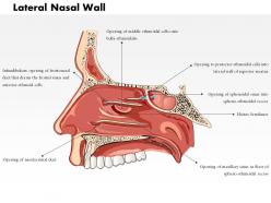 0514 lateral nasal wall medical images for powerpoint