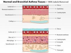 0514 normal and bronchial asthma tissues medical images for powerpoint