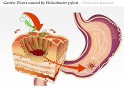 0614 gastric ulcers caused by helicobacter pylori medical images for powerpoint