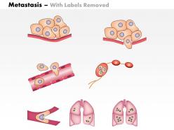 0614 metastasis biology medical images for powerpoint
