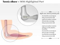 0614 tennis elbow medical images for powerpoint