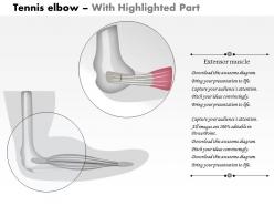 0614 tennis elbow medical images for powerpoint