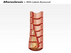 0714 atherosclerosis medical images for powerpoint