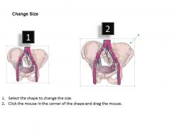 0714 iliac nodes medical images for powerpoint