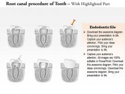 0714 illustration of root canal procedure of tooth