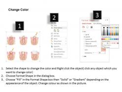 0714 illustration of root canal procedure of tooth