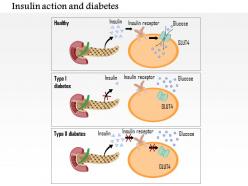 0714 insulin action and diabetes type 1 and type 2 medical images for powerpoint