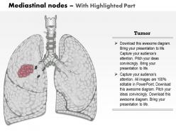 0714 mediastinal nodes medical images for powerpoint