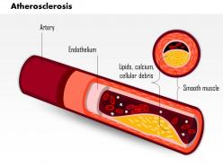 0814 atherosclerosis medical images for powerpoint