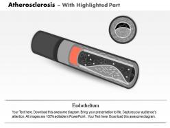 0814 atherosclerosis medical images for powerpoint