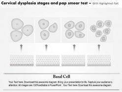 0814 cervical dysplasia stages and pap smea test medical images for powerpoint