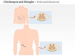 0814 chickenpox and shingles medical images for powerpoint