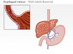 0814 esophageal varices medical images for powerpoint