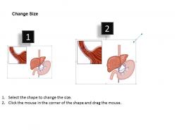 0814 esophageal varices medical images for powerpoint