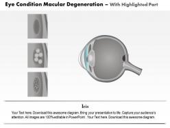 0814 eye condition macular degeneration medical images for powerpoint