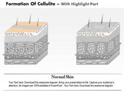 0814 formation of cellulite medical images for powerpoint