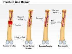 0814 fracture and repair medical images for powerpoint