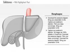 0814 gallstones medical images for powerpoint
