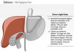 0814 gallstones medical images for powerpoint