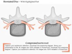 0814 herniated disc medical images for powerpoint