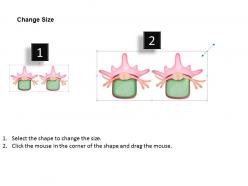 0814 herniated disc medical images for powerpoint