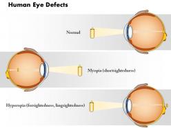 0814 human eye defects myopia and hyperopia medical images for powerpoint