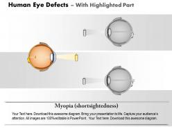 0814 human eye defects myopia and hyperopia medical images for powerpoint