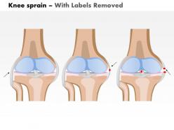 0814 knee sprain medical images for powerpoint