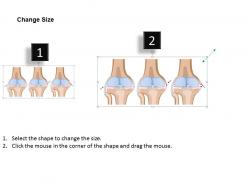 0814 knee sprain medical images for powerpoint