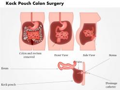 0814 kock pouch colon surgery medical images for powerpoint