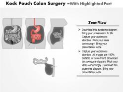 0814 kock pouch colon surgery medical images for powerpoint