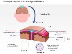 0814 meningitis infection of the meninges of the brain medical images for powerpoint