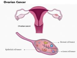 0814 ovarian cancer medical images for powerpoint