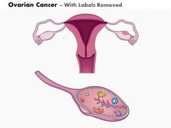 0814 ovarian cancer medical images for powerpoint