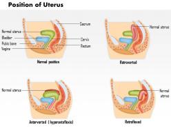 0814 position of uterus medical images for powerpoint