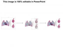 0814 pulmonary edema medical images for powerpoint