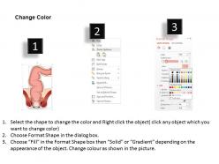 0814 rectum medical images for powerpoint